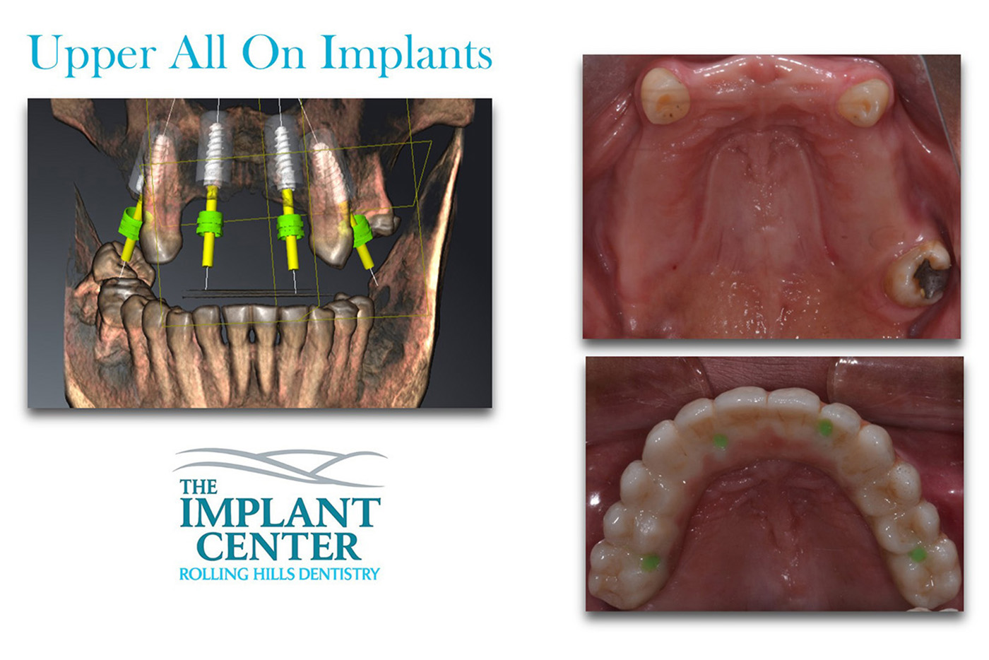Rolling Hills Dentistry | Inlays amp Onlays, TMJ Disorders and Laser Dentistry
