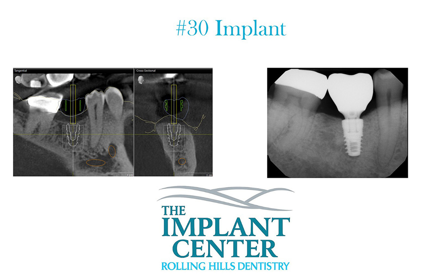 The Implant Center Rolling Hills Dentistry
