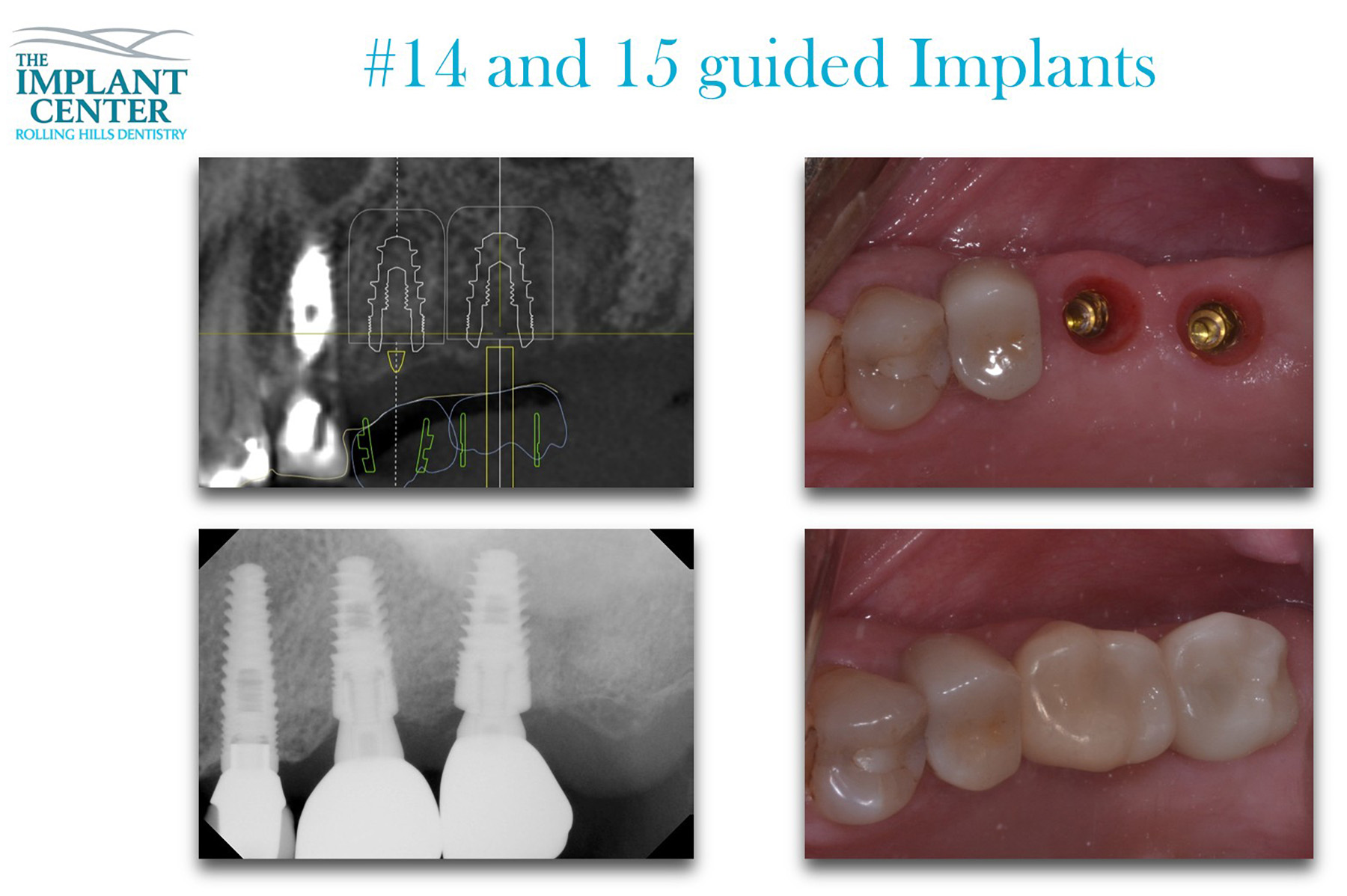 The Implant Center Rolling Hills Dentistry