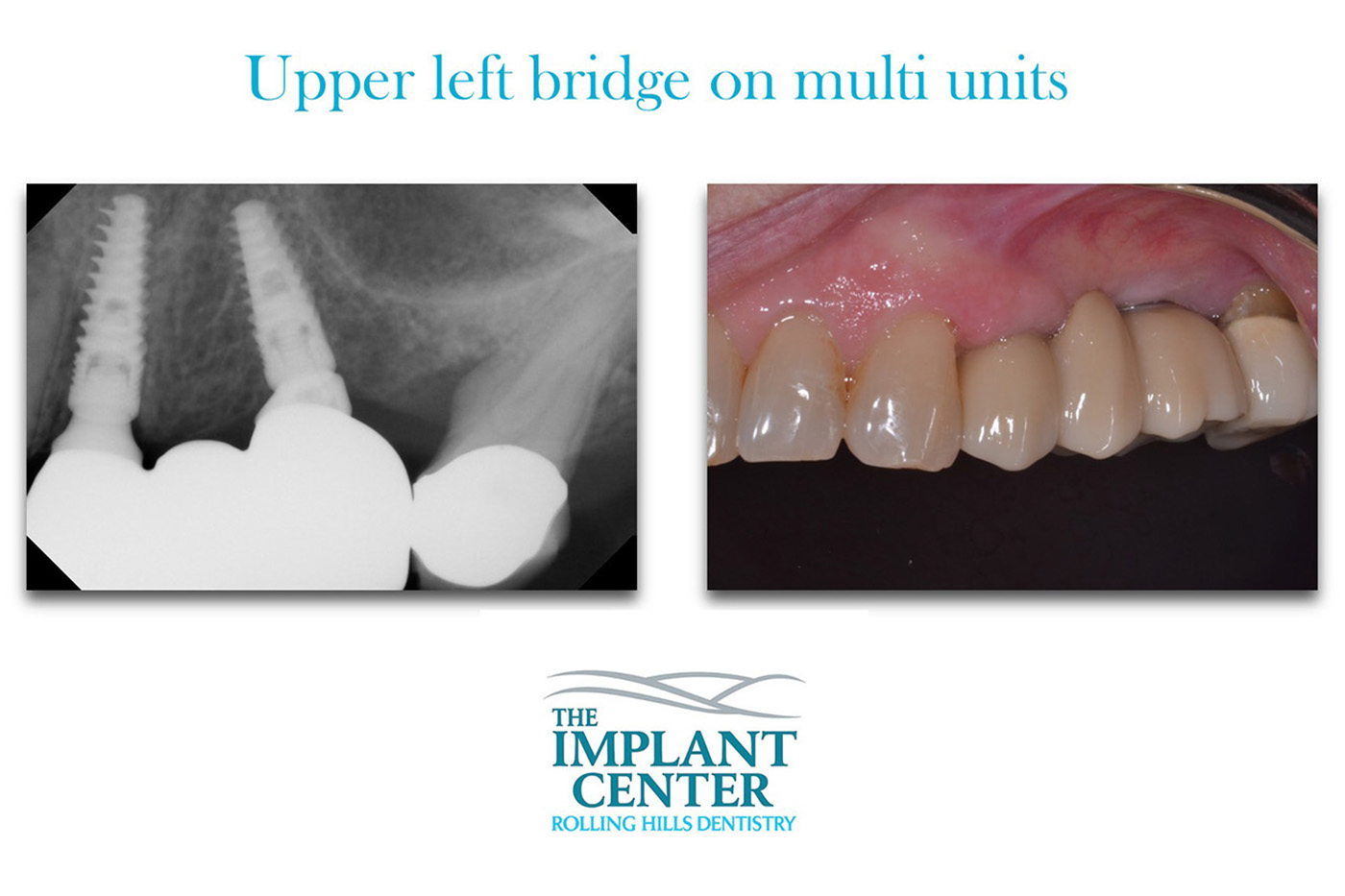 Rolling Hills Dentistry | Implant Restorations, All-on-4 reg and Night Guards