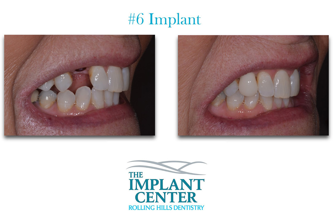 The Implant Center Rolling Hills Dentistry