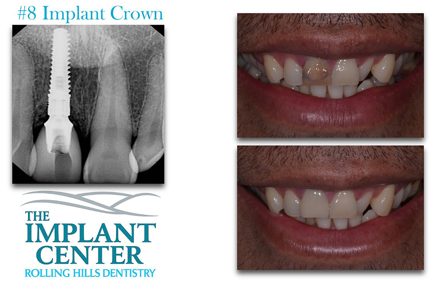 The Implant Center Rolling Hills Dentistry