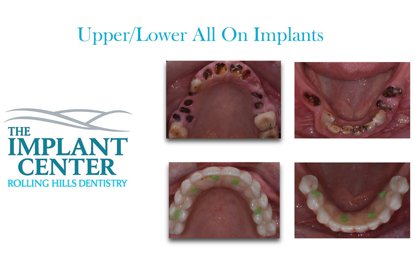 The Implant Center Rolling Hills Dentistry