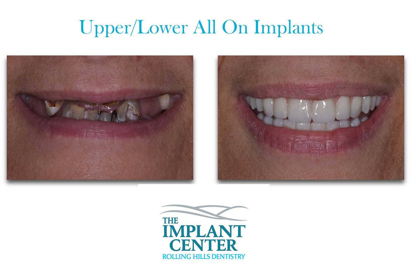 The Implant Center Rolling Hills Dentistry