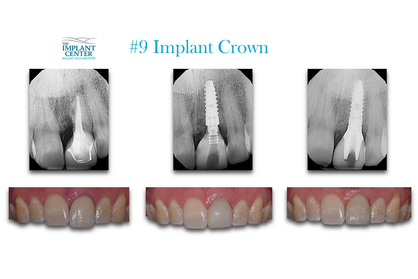 The Implant Center Rolling Hills Dentistry